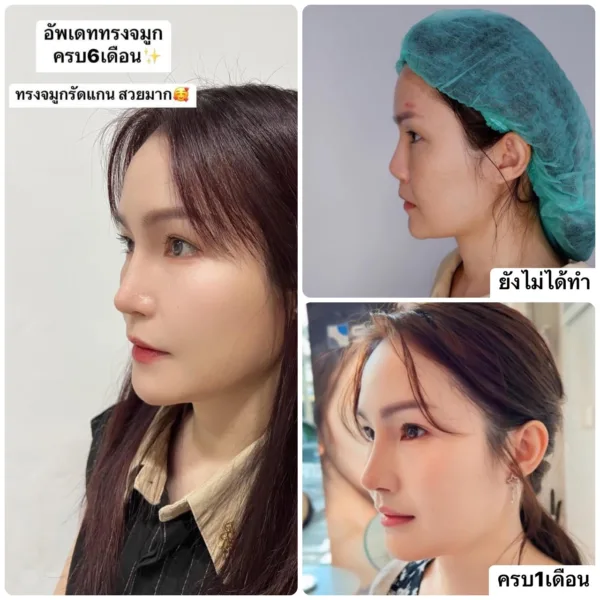 แก้จมูก