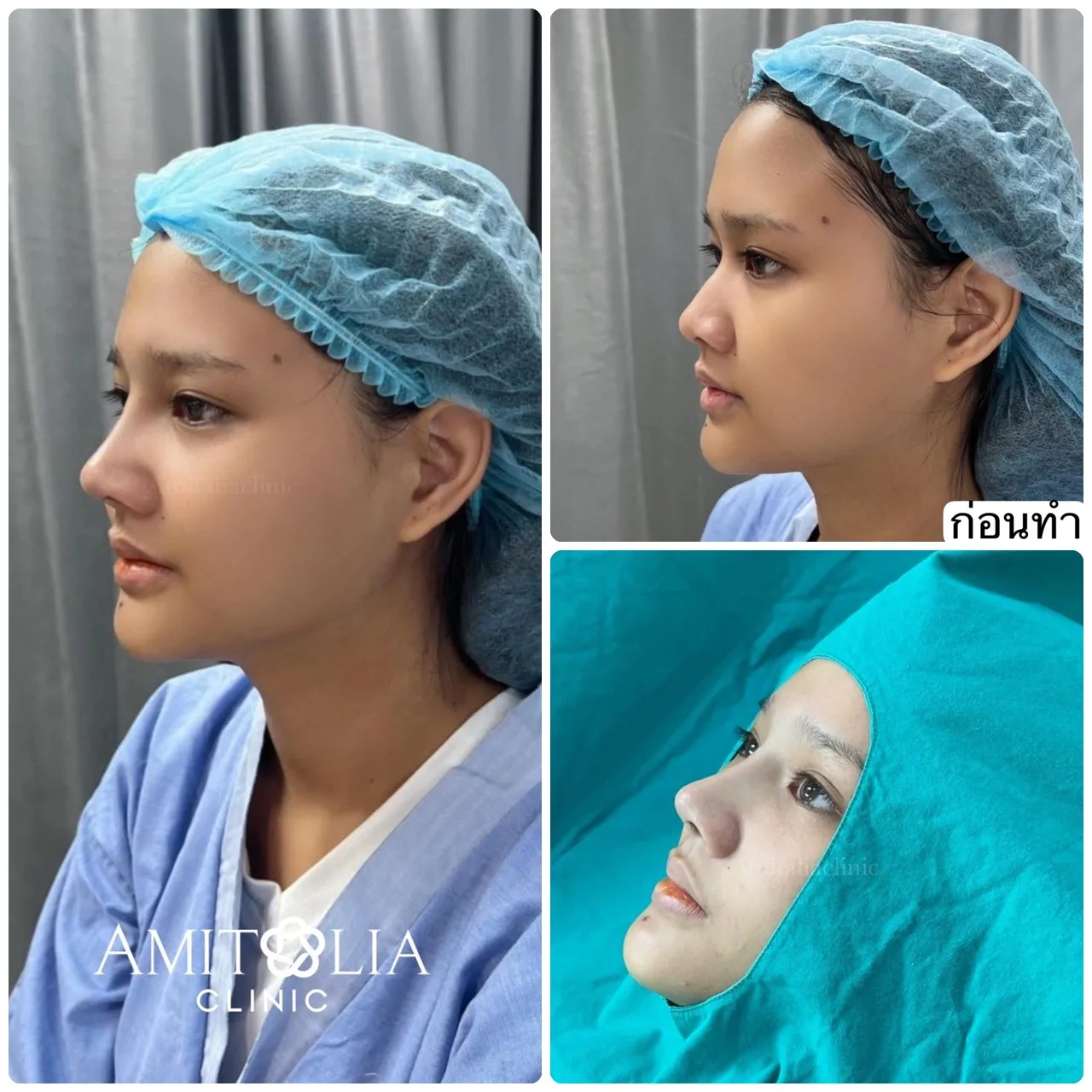 ทรงจมูกสวยๆ หลังเสริมเสร็จทันที