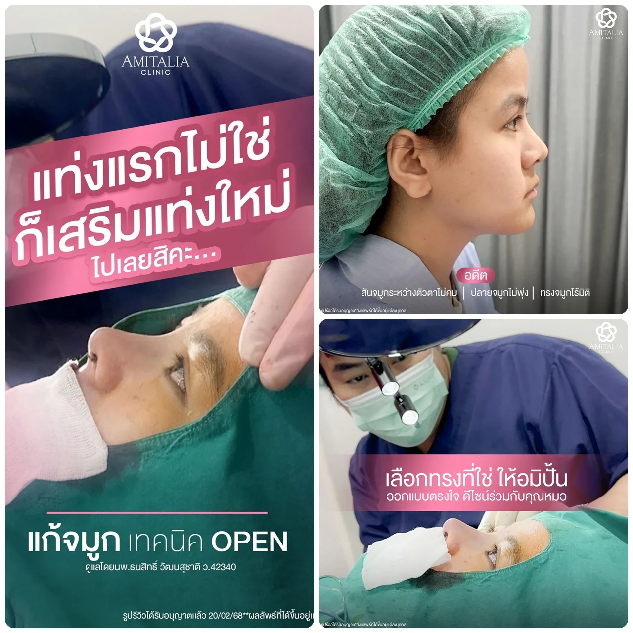 จมูกใหม่ หน้าเปลี่ยน มั่นใจไม่ต้องกลัวทะลุ