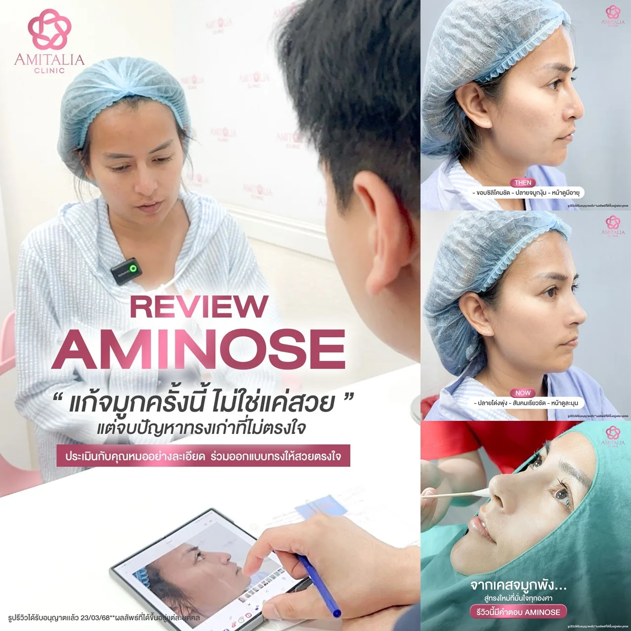 แก้จมูกครั้งนี้ จบปัญหาเดิมที่พังมานาน