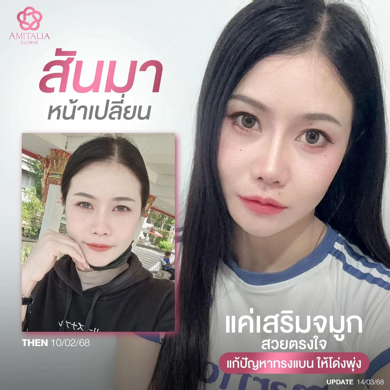 ทรงจมูกเปลี่ยนหน้าเปลี่ยน