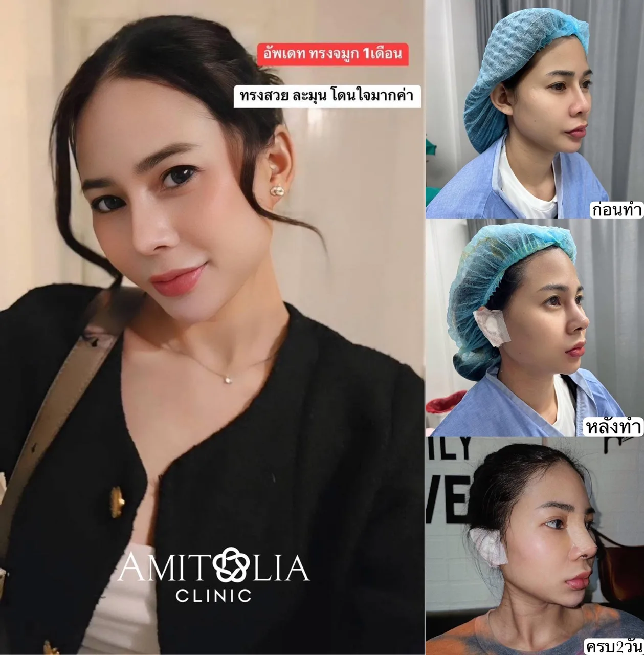 รีวิวแก้จมูก ครบ1เดือนค้า