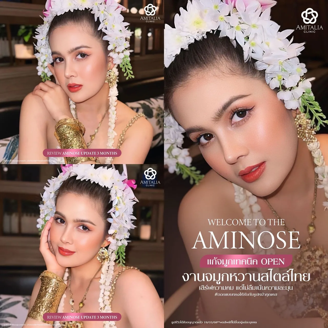 รีวิวแก้จมูกครบ 3 เดือน เทคนิค OPEN