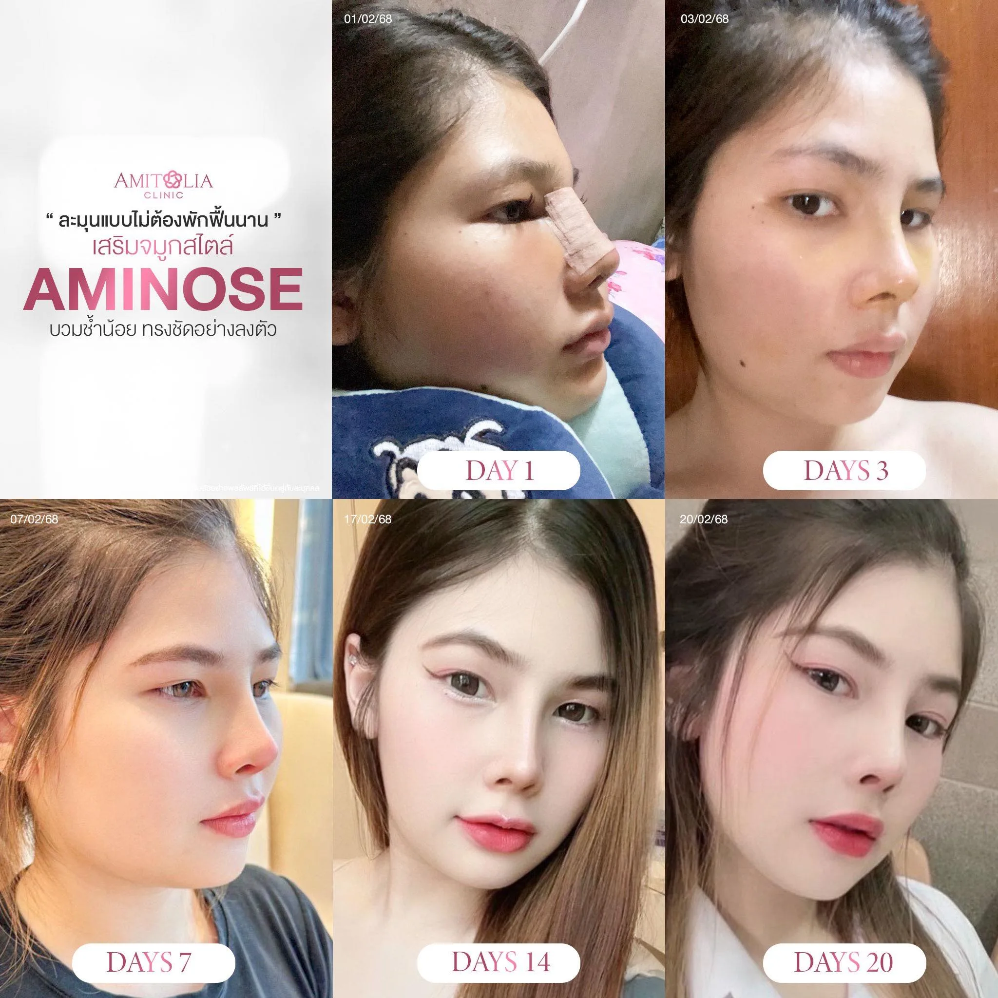 จมูกใหม่ ไม่ต้องรอเข้าที่นาน