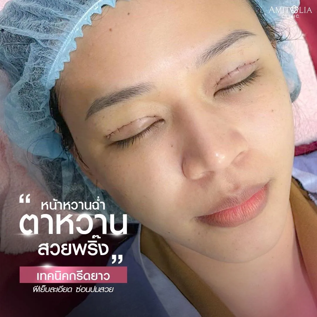 กล้าโชว์ กล้าเสริฟ… #แผลตาสองชั้น