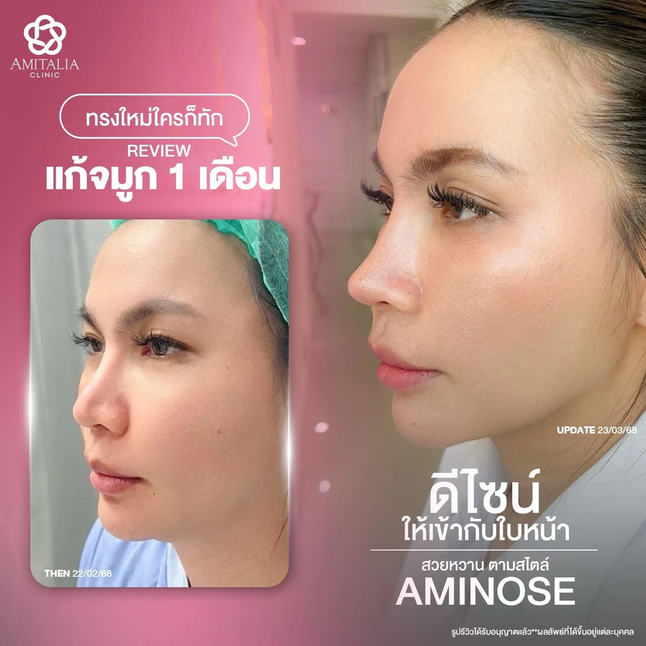 รีวิวเคสแก้จมูก 1 เดือน