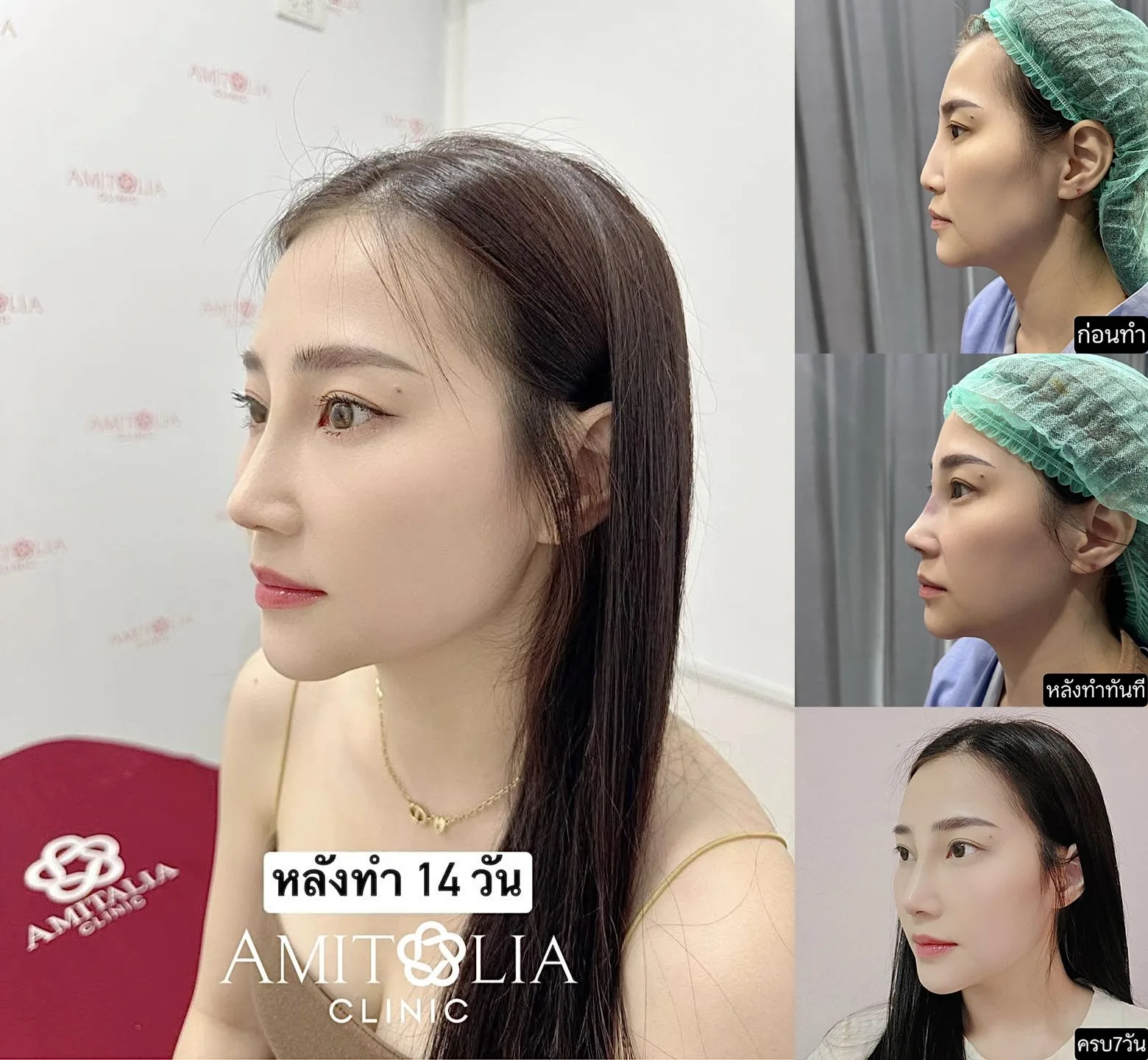แค่แก้จมูก…ใบหน้าก็เปลี่ยนเป็นสวยหวานละมุนมากขึ้น