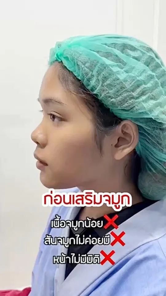 เนื้อจมูกน้อย