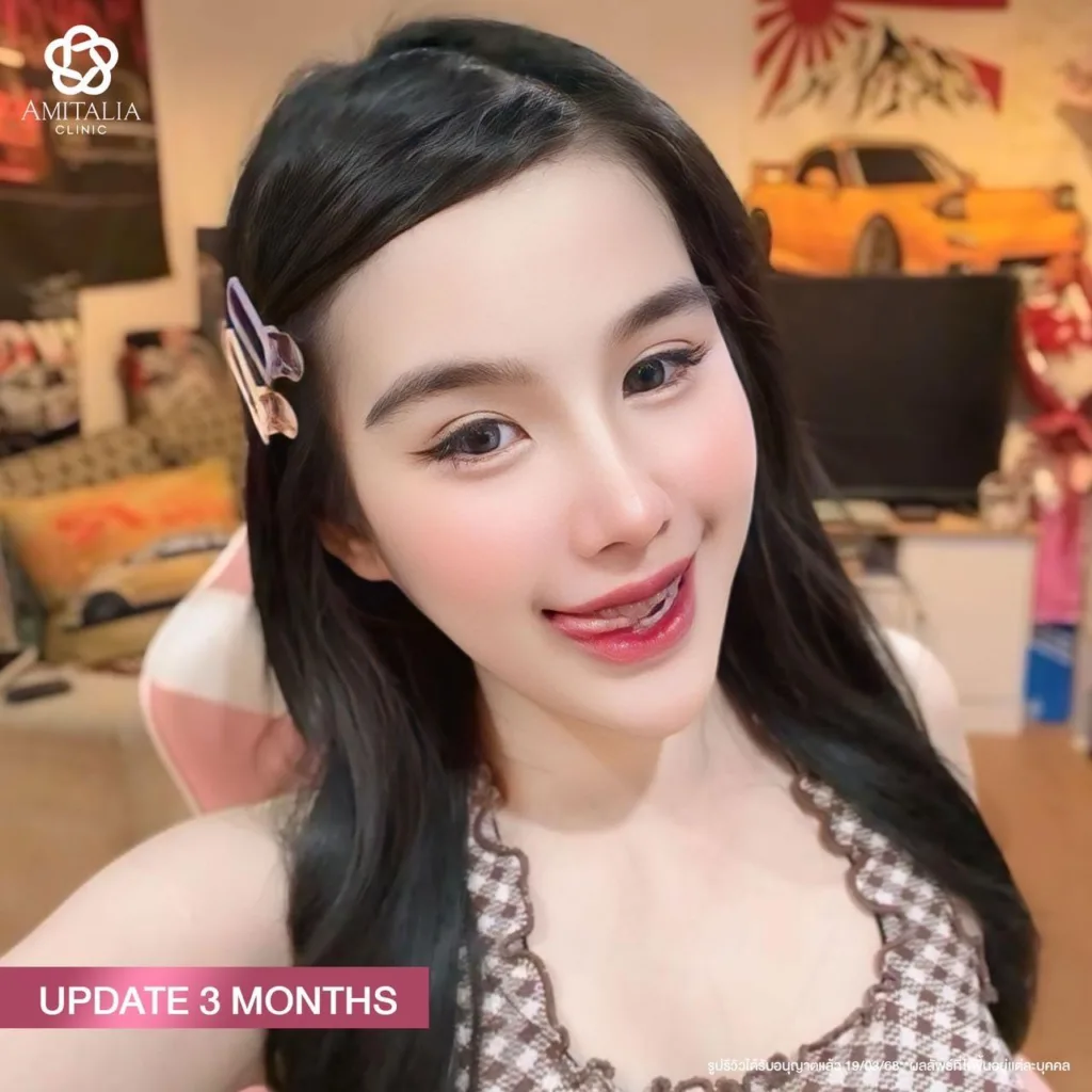 แก้จมูก