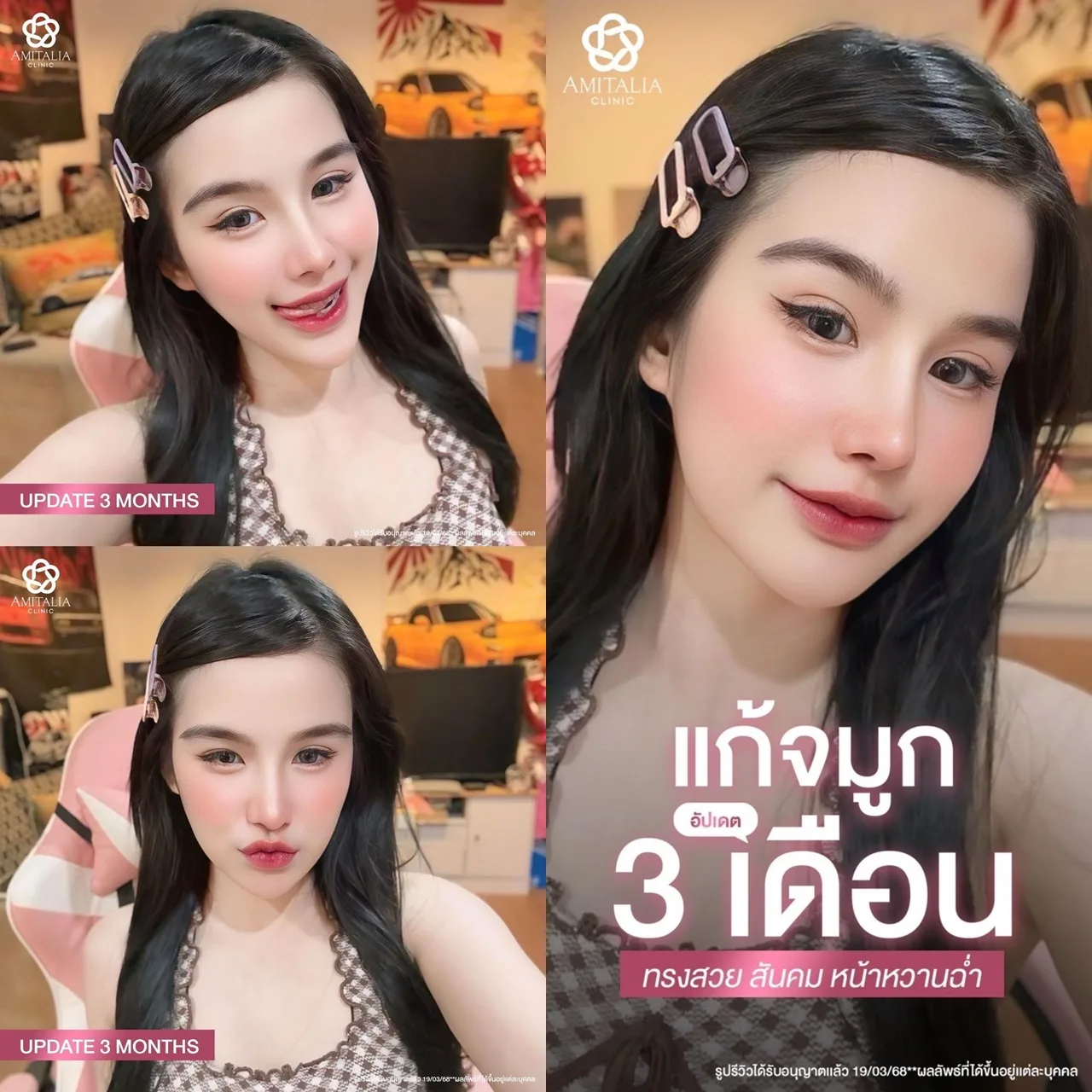 แก้จมูกทรงโด่งพุ่งสวยหวานในมุมเดียวกัน