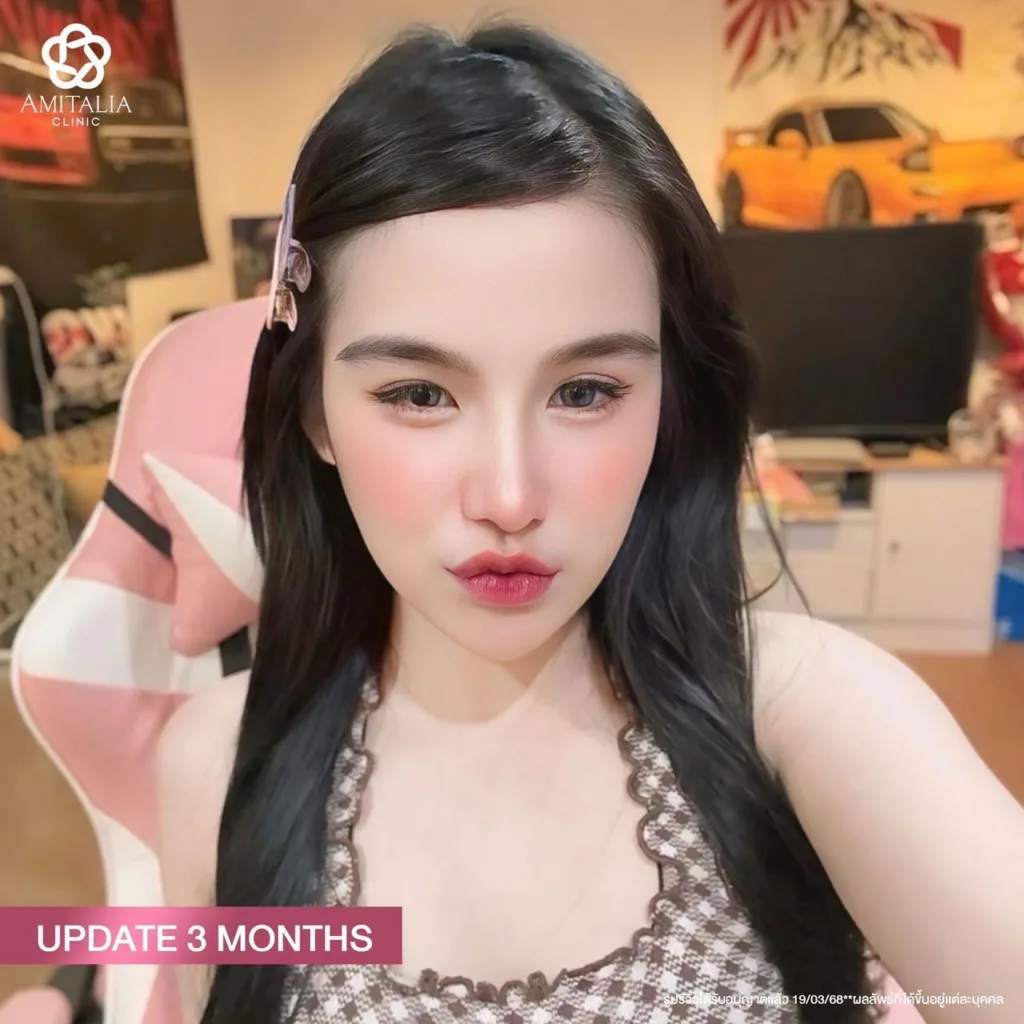 แก้จมูก