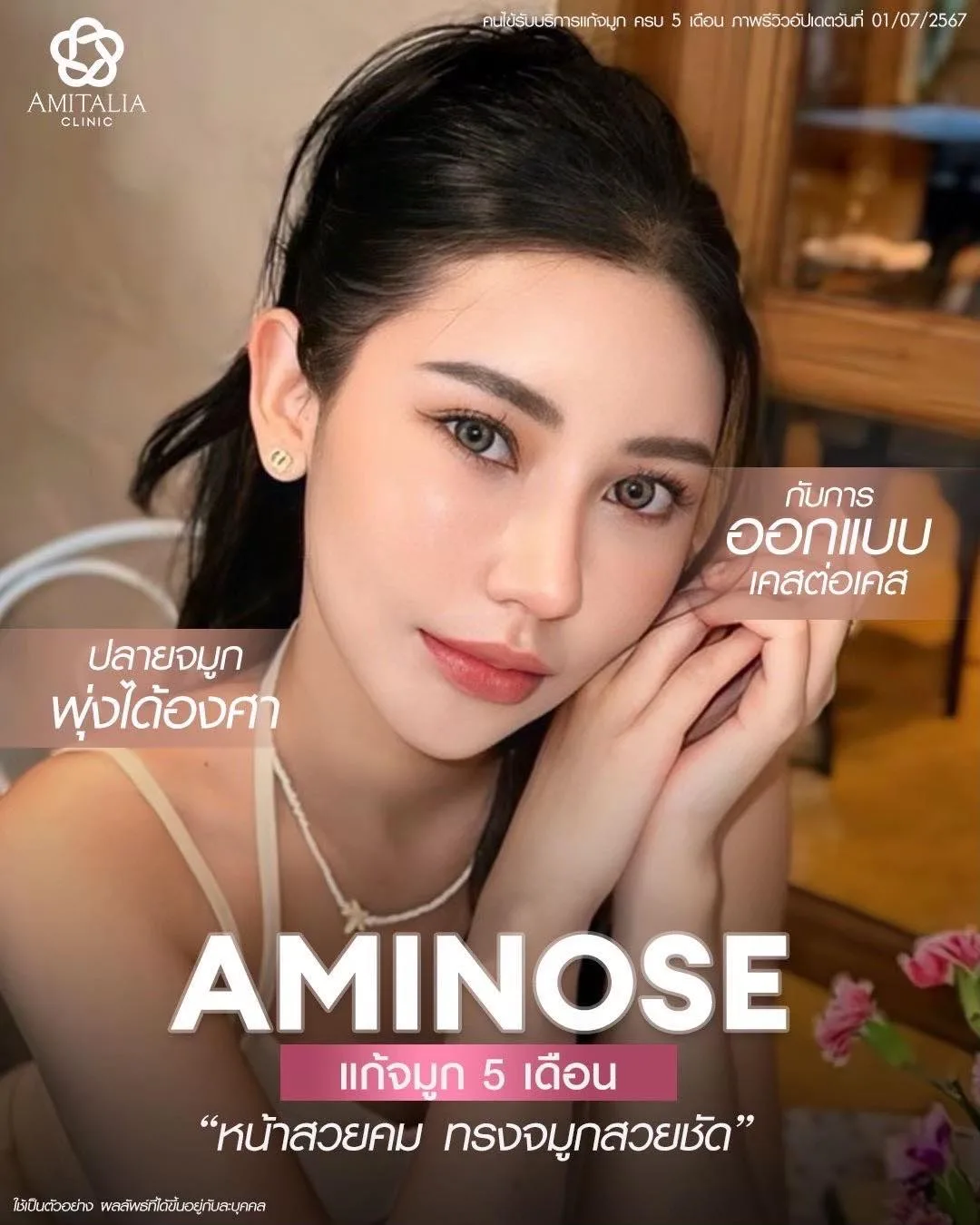 รีวิว แก้จมูกครบ5เดือน ยิ่งนานยิ่งสวยปัง