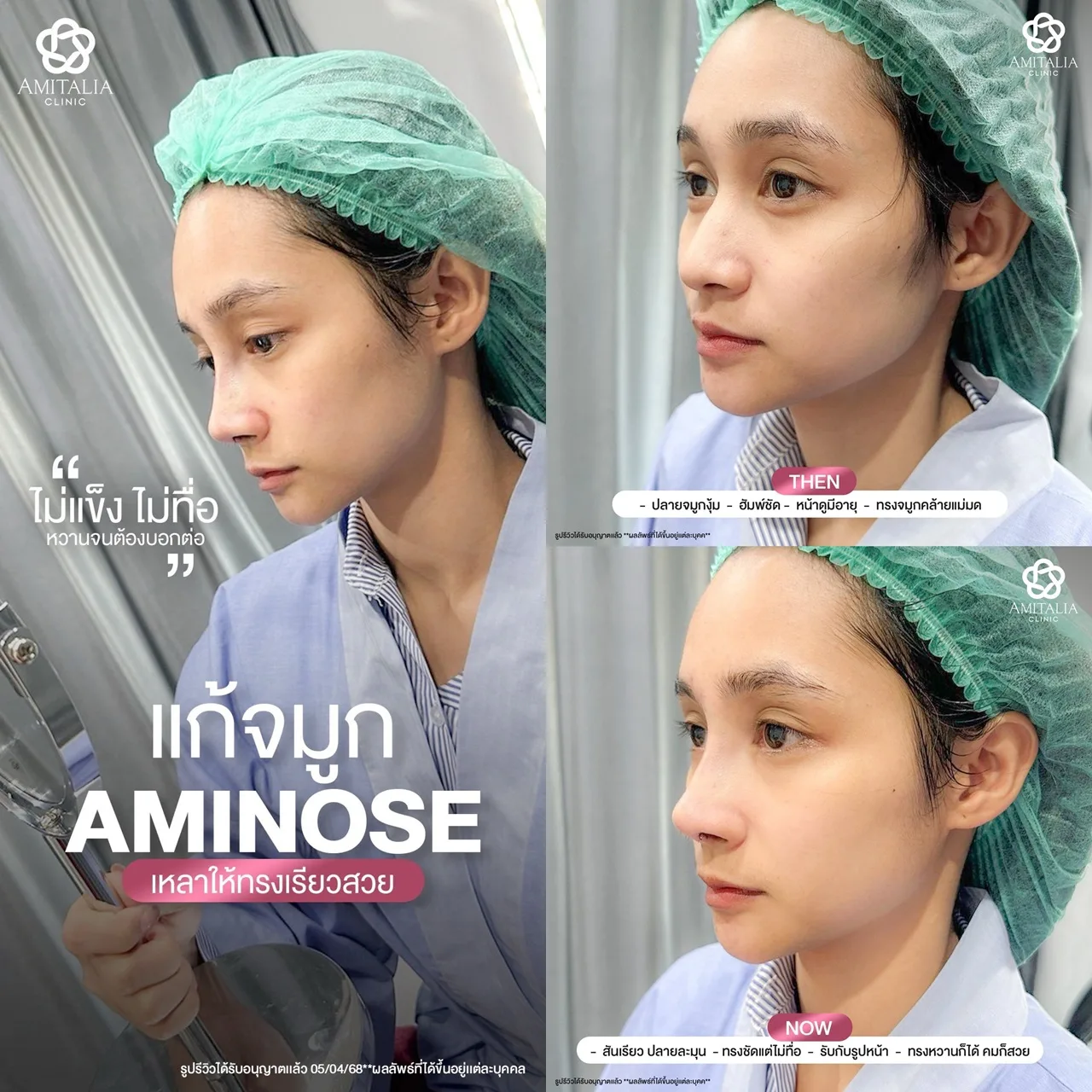 งานแก้จมูกที่ไม่ได้แค่แก้ แต่คืนความมั่นใจ
