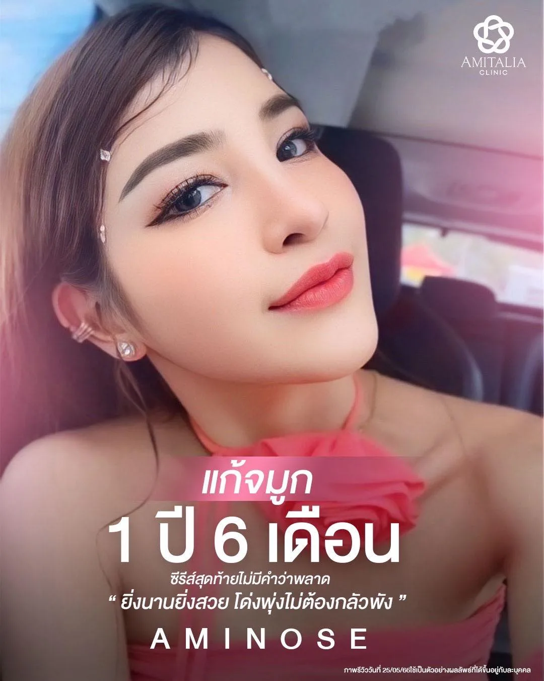 รีวิวแก้จมูก 1 ปี 6 เดือนเต็ม!