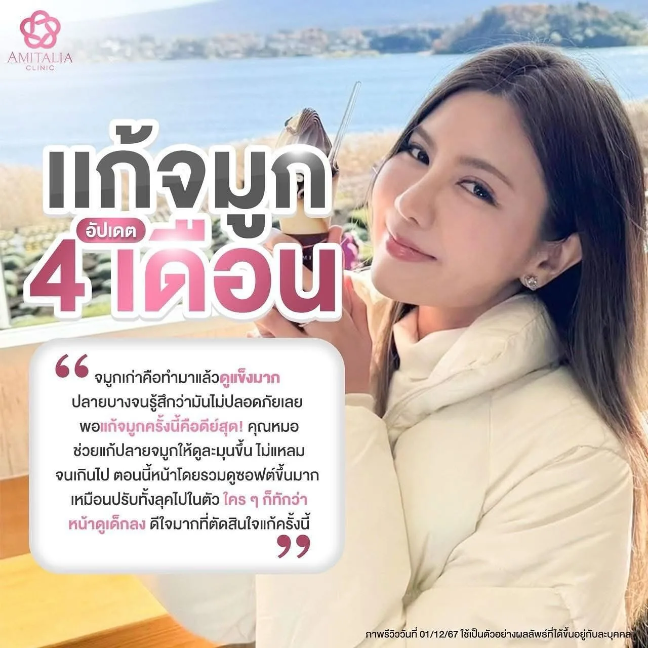 จมูกที่ช่วยส่งเสริมให้คนไข้ หน้าเด็กหน้าหวาน