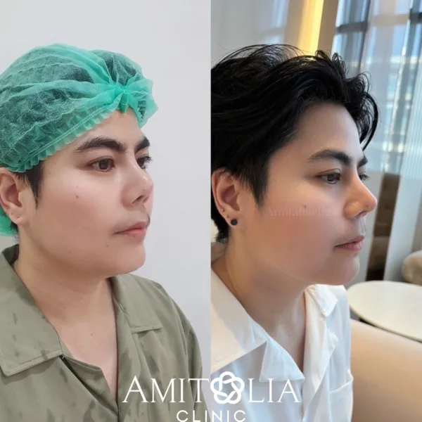 ปลายจมูกเหิน