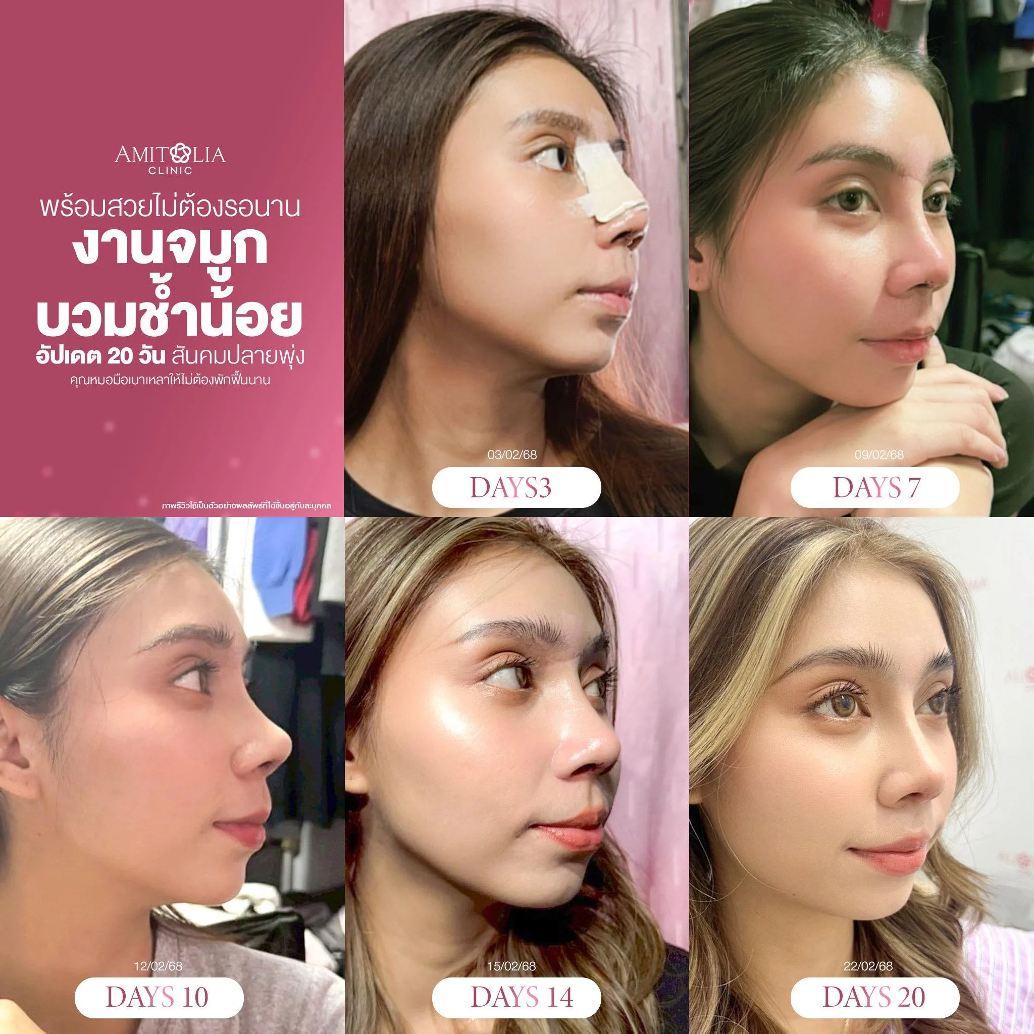 งานจมูกไม่ต้องพักยาว แค่ 20 วันพร้อม!