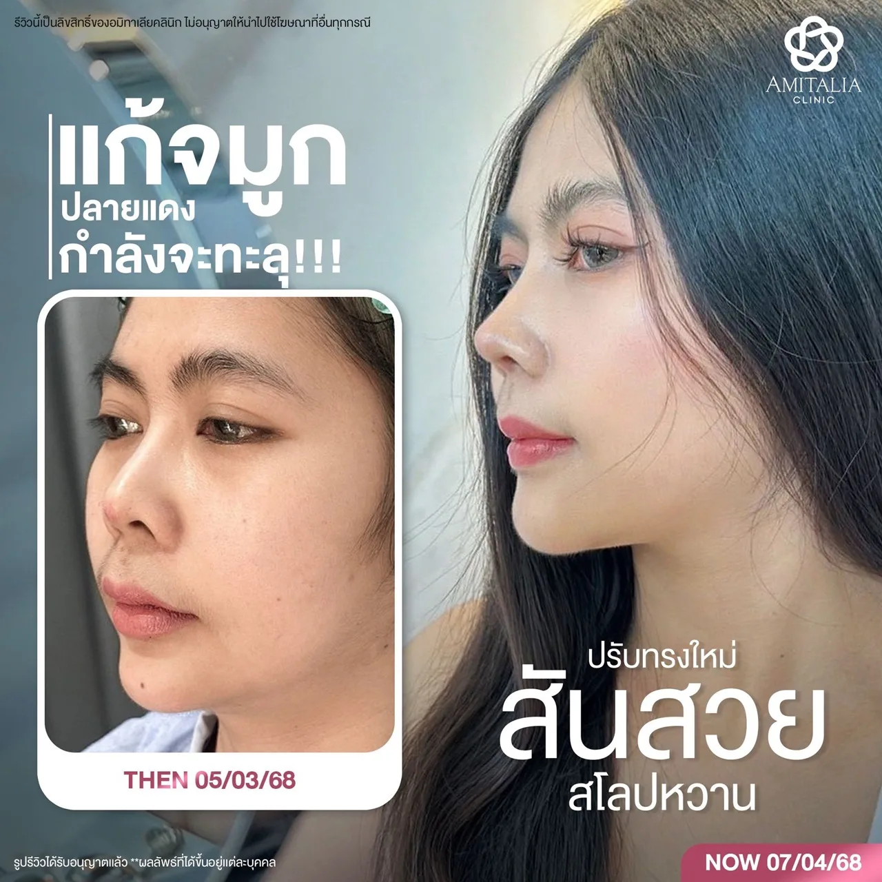 แก้จมูกครบ 1 เดือน #ทรงใหม่คือดีต่อใจไม่ไหว