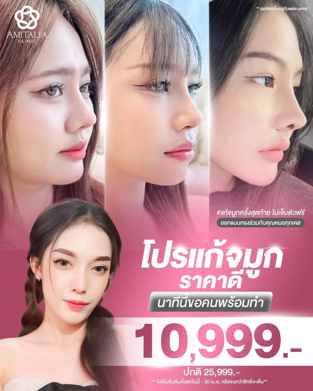 โปรแก้จมูกราคาดี 10,999.- (ปกติ 25,999.-)