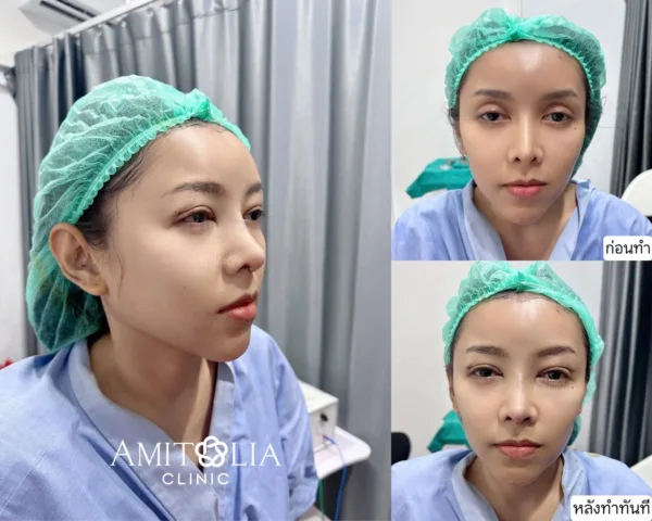 แก้จมูกเทคนิคโอเพ่น