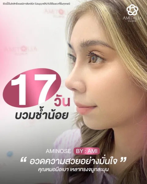 เสริมจมูก