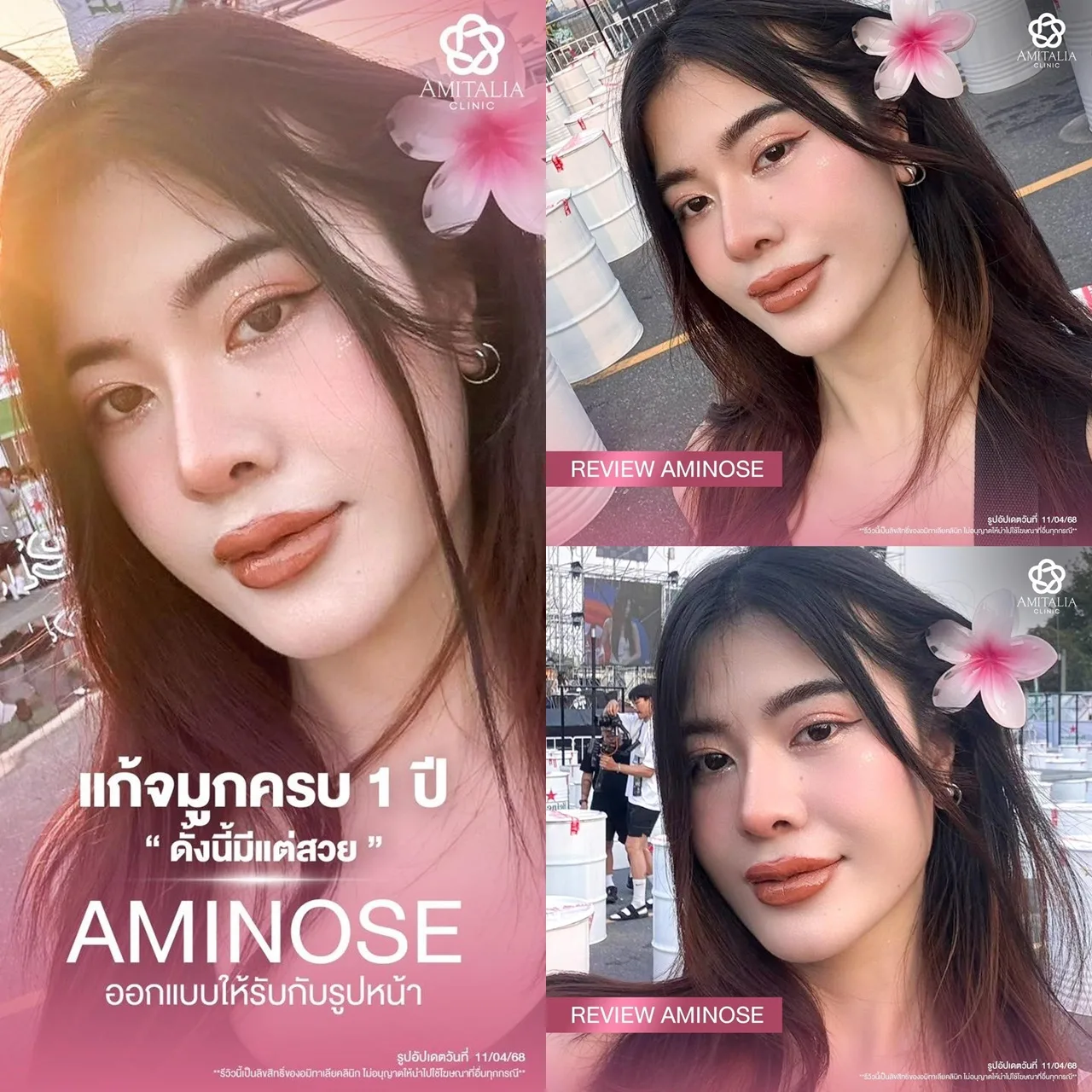 รีวิว แก้จมูกครบ1ปียิ่งนานยิ่งสวยปัง