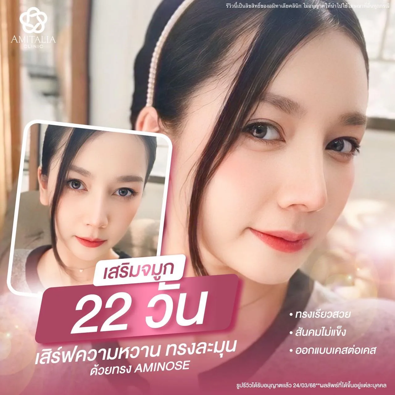 ทำจมูกครั้งแรกยังไงไม่ให้มีแผลใจ