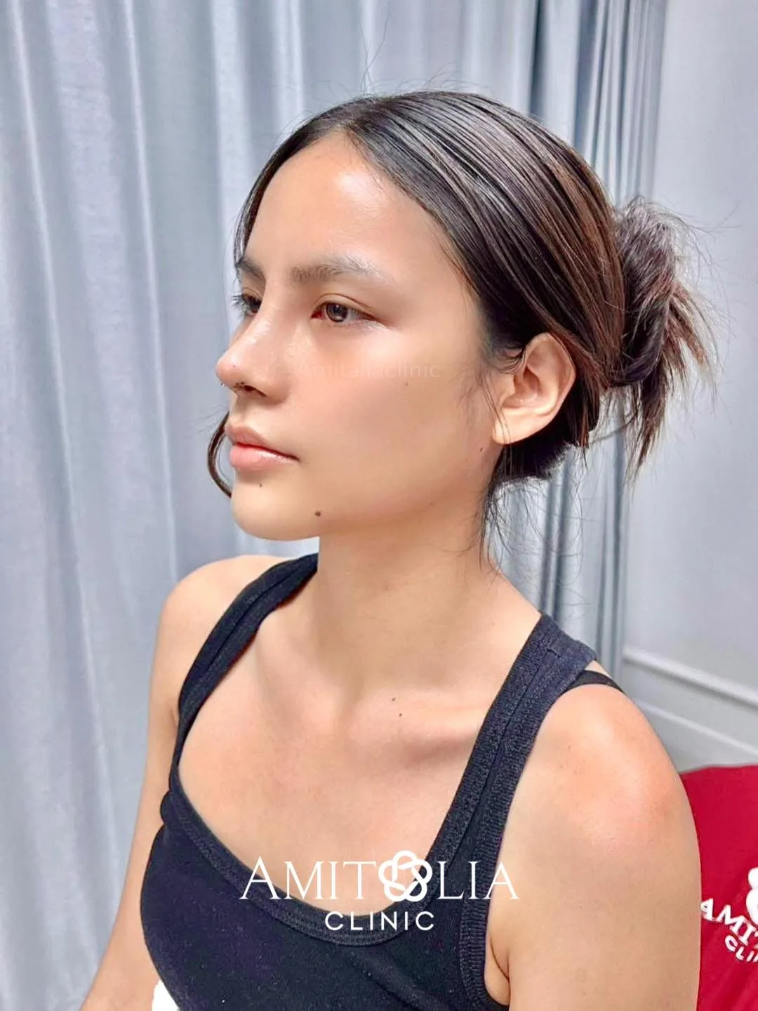 ทรงจมูกยอดฮิต โด่งพุ่งสวยหวานในมุมเดียวกัน