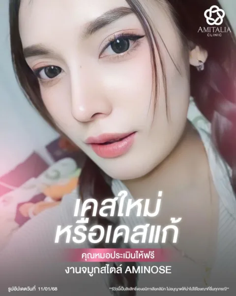 เคยเสริมจมูกมาแล้ว