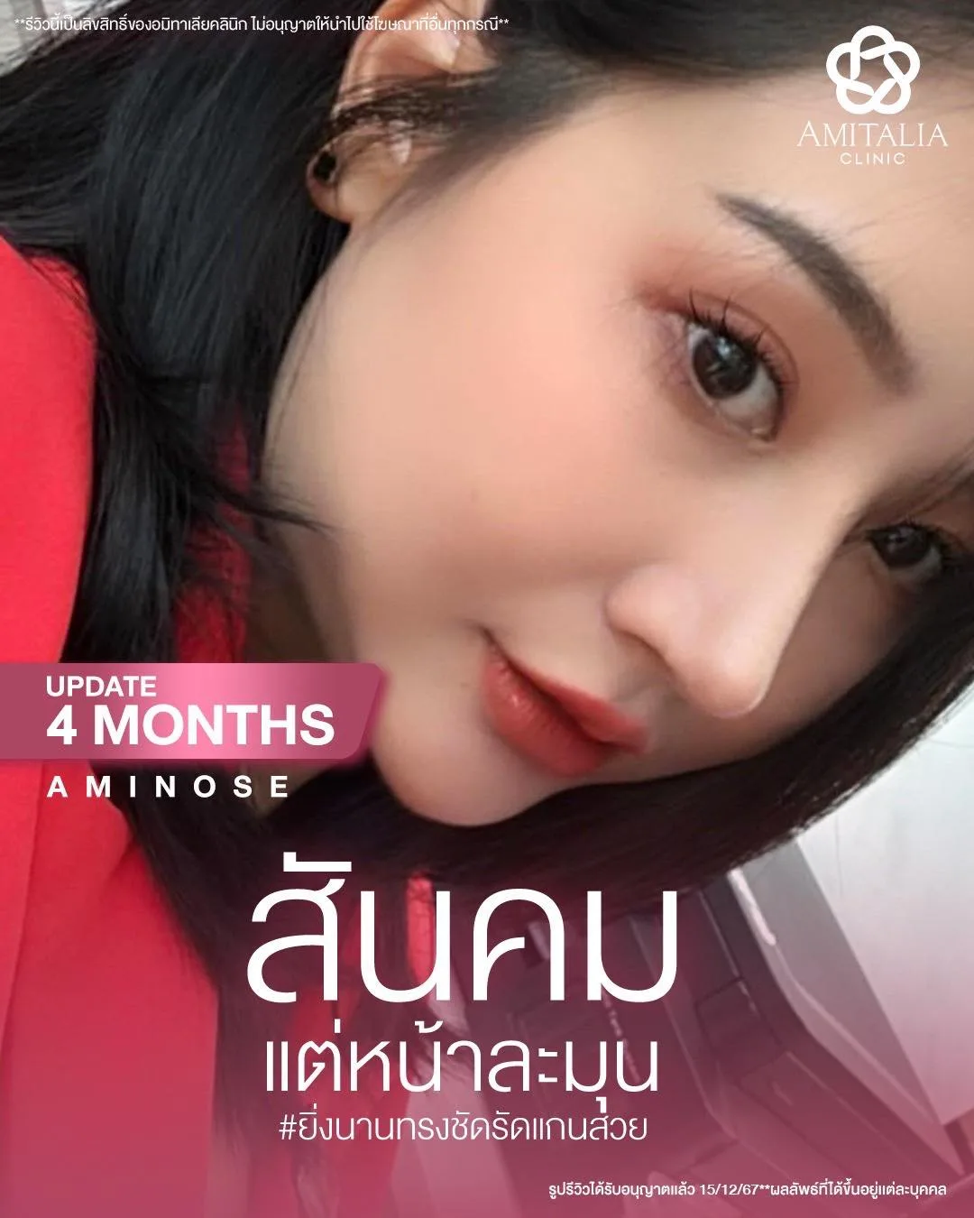 อัปเตด 4 เดือนงานจมูก Aminose