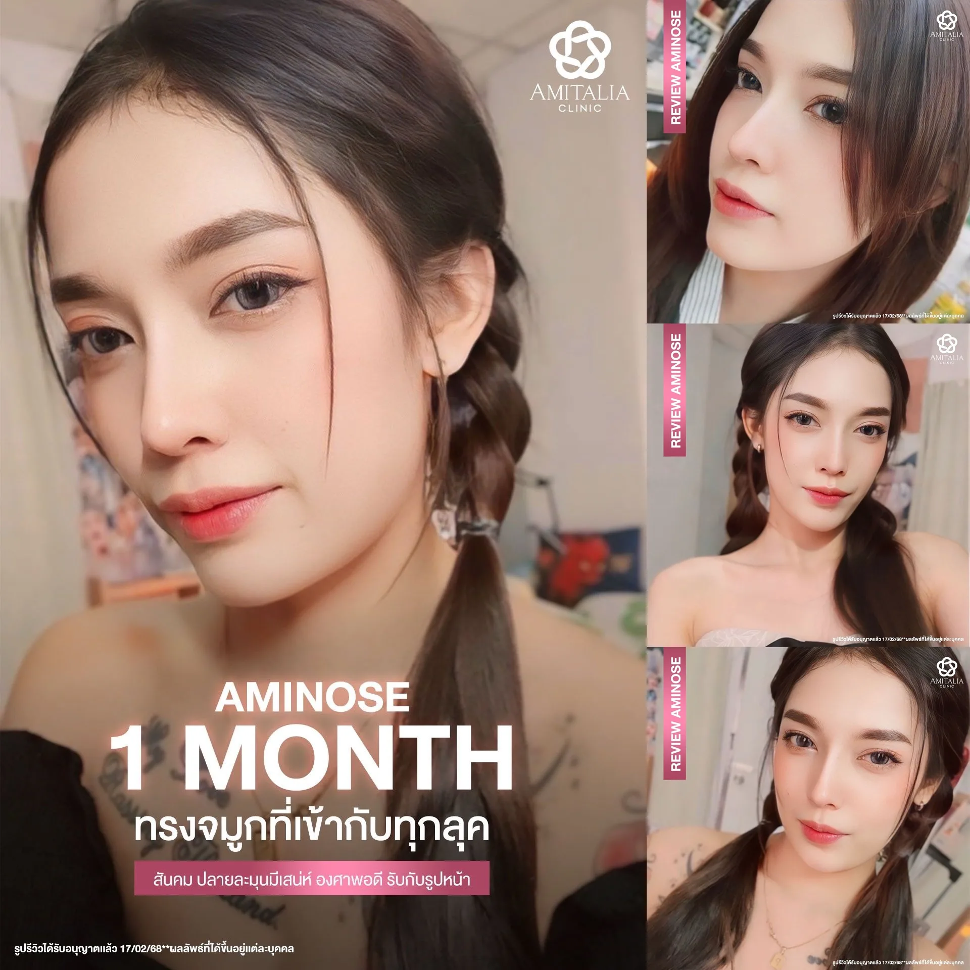 อัปเดต 1 เดือน ทรงจมูกสไตล์ AMINOSE