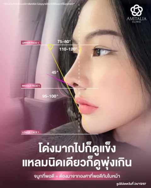 เสริมจมูก