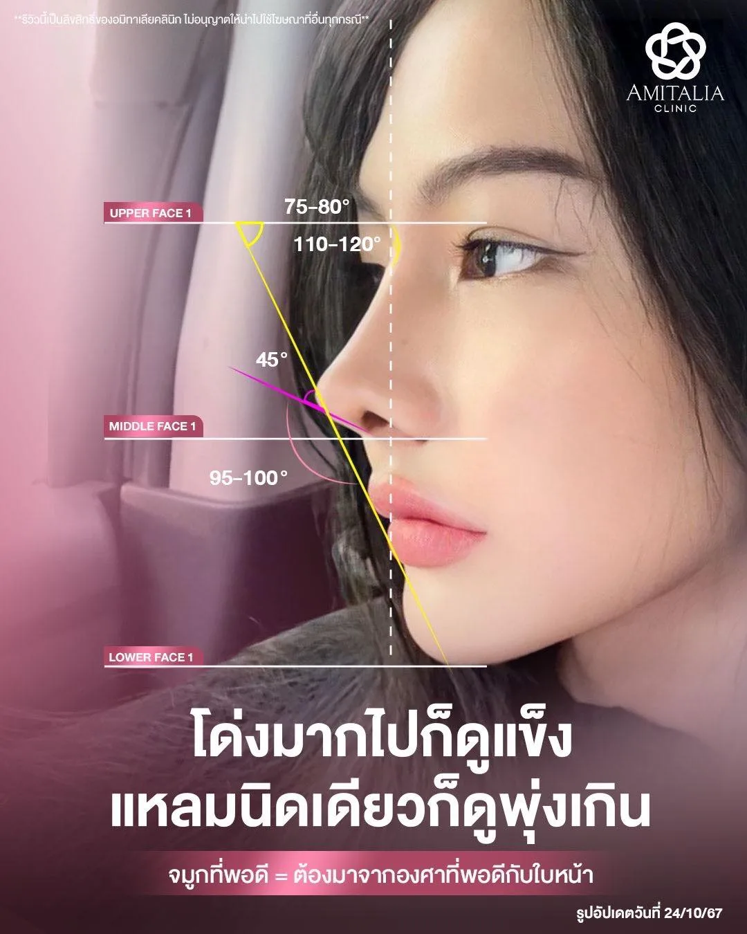 เสริมจมูก