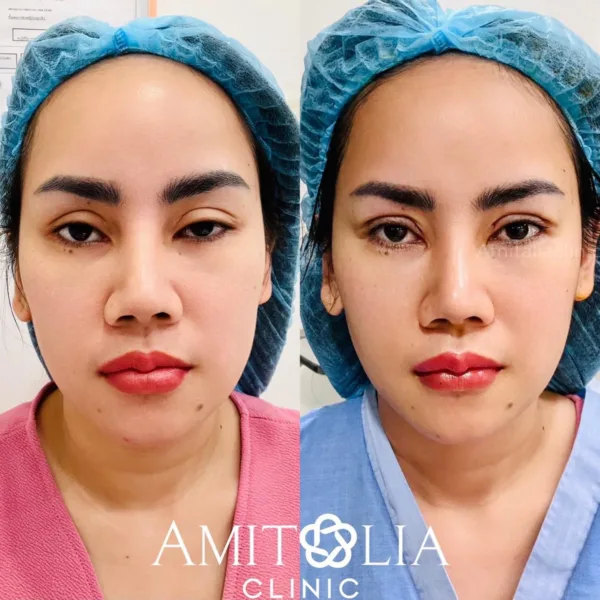 แก้กล้ามเนื้อตา