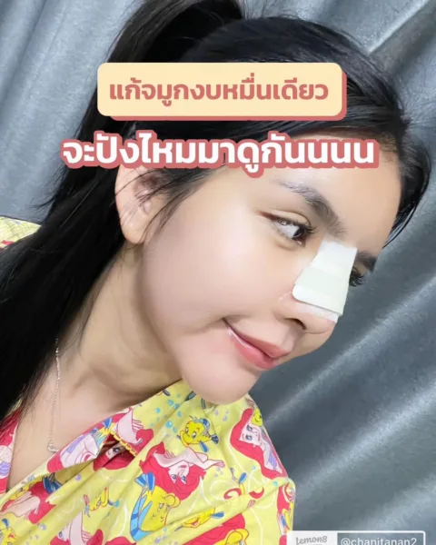 แก้จมูก