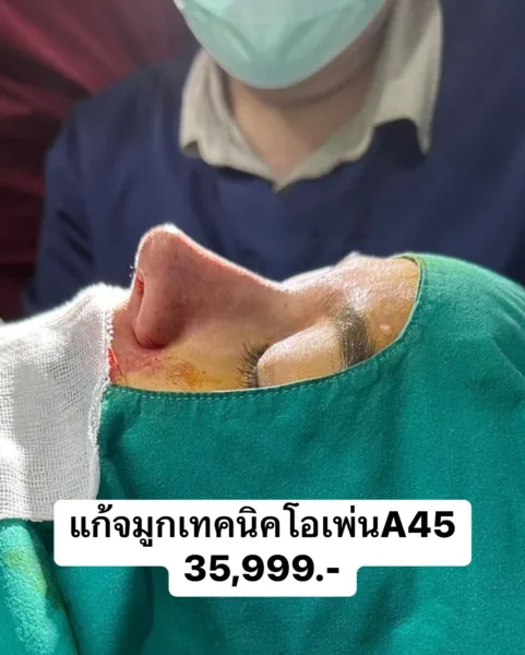 แก้จมูกเทคนิคโอเพ่น