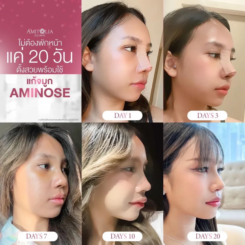 รีวิวแก้จมูก