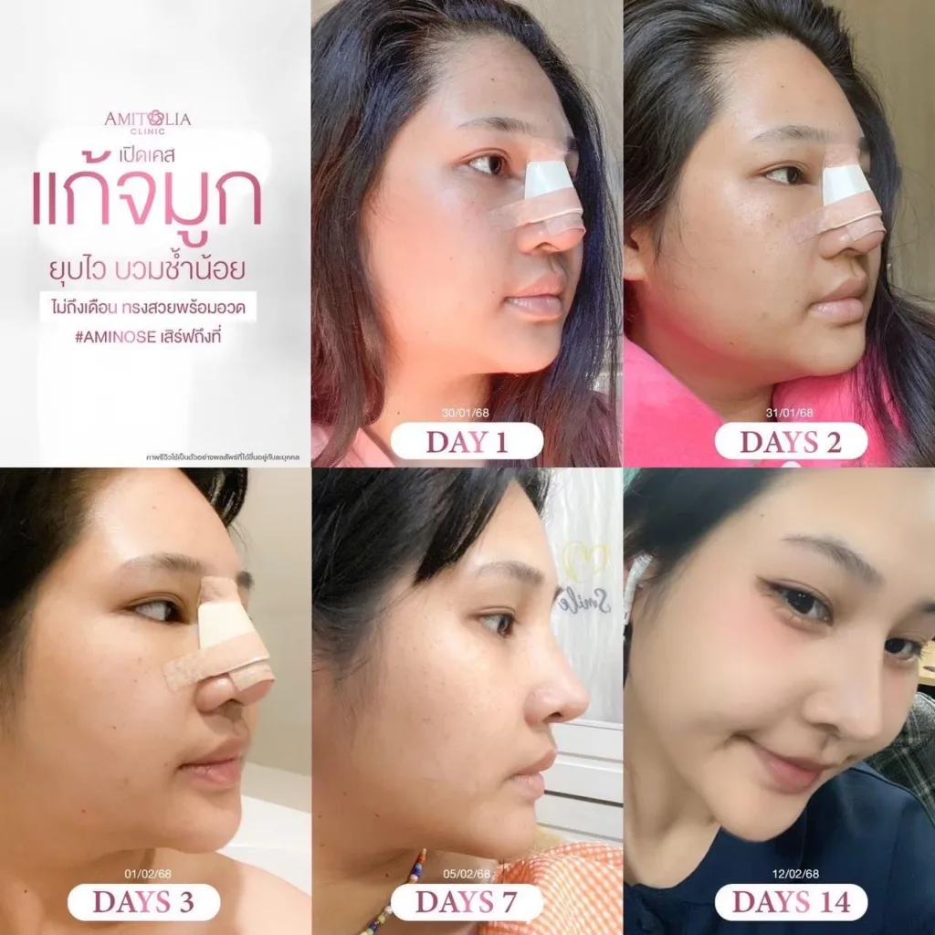 รีวิวแก้จมูก