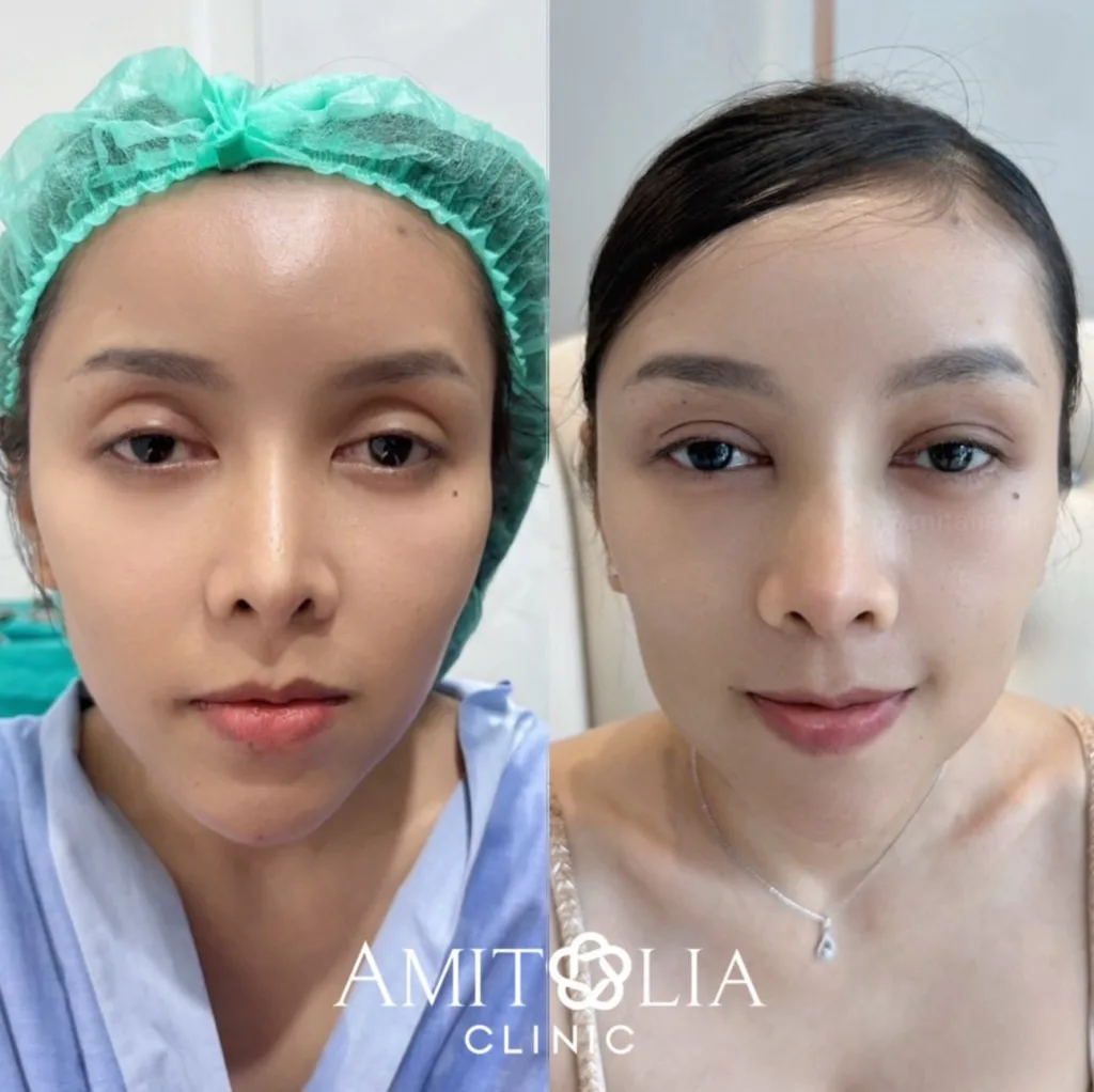 แก้ปัญหาเบ้าตาลึก