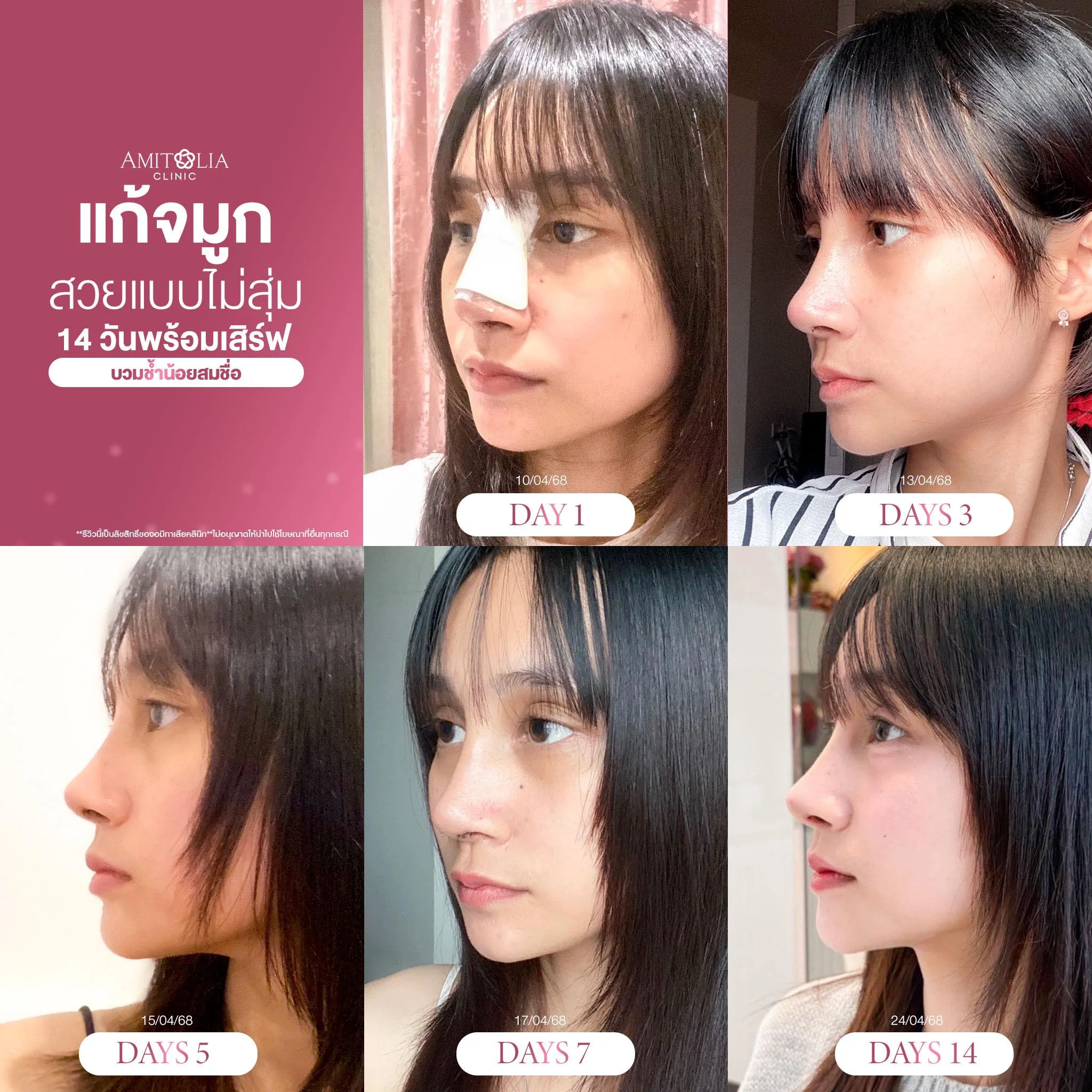 แก้จมูก
