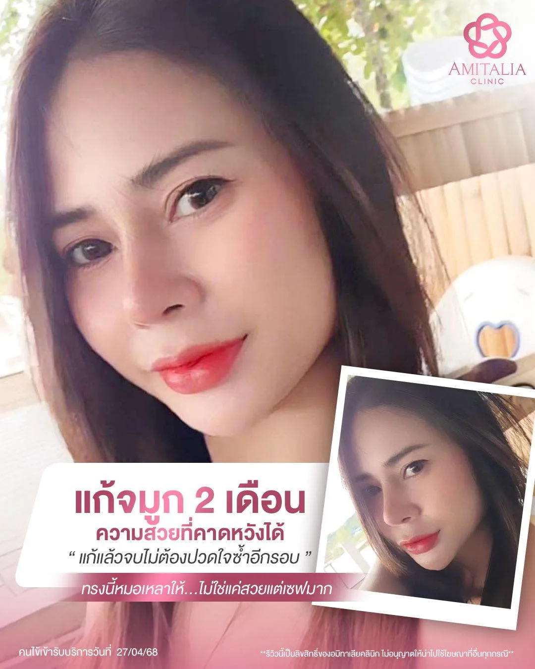 แก้จมูก