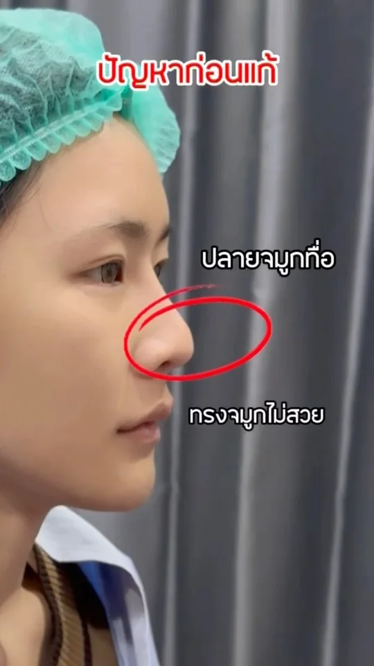 แก้จมูก
