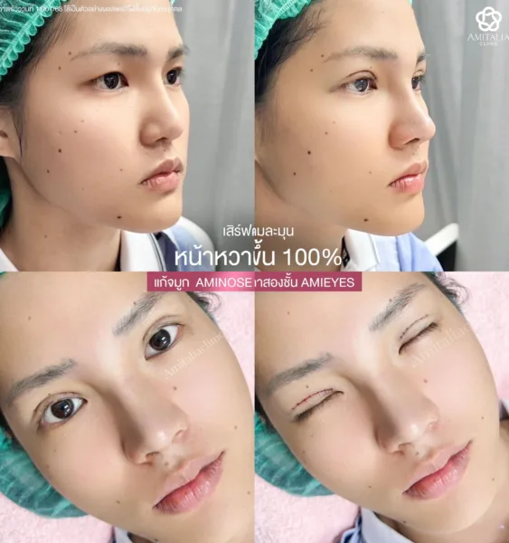 ศัลยกรรมจมูกและตา