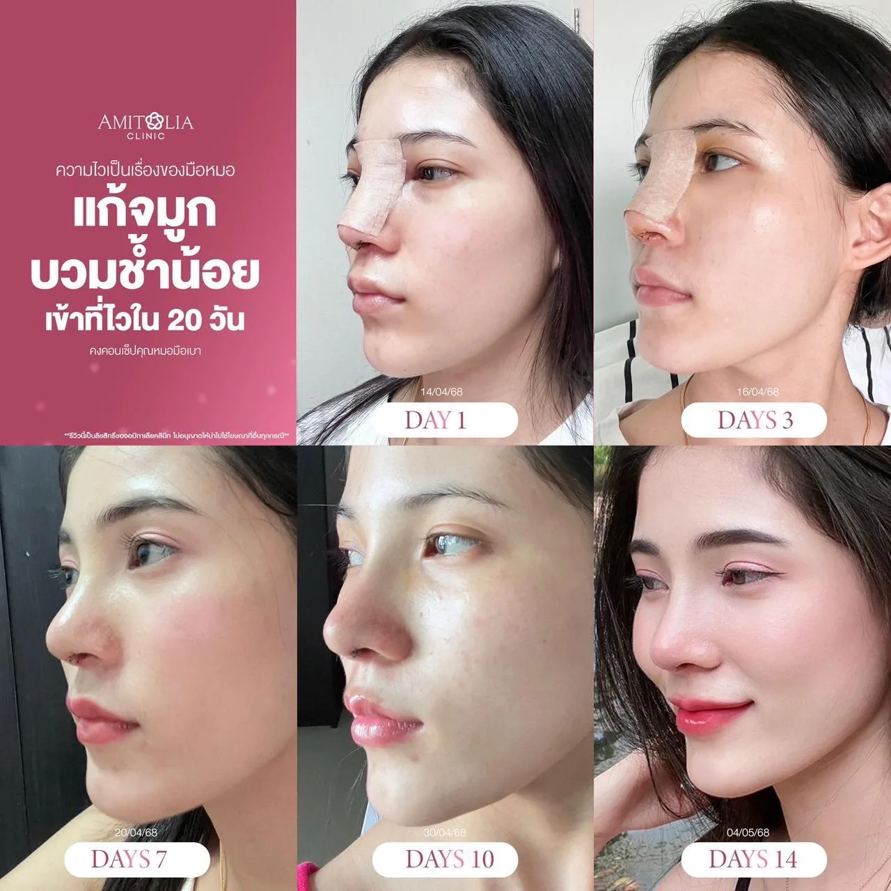 แก้จมูก