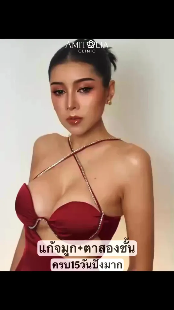 แก้จมูกโอเพ่น