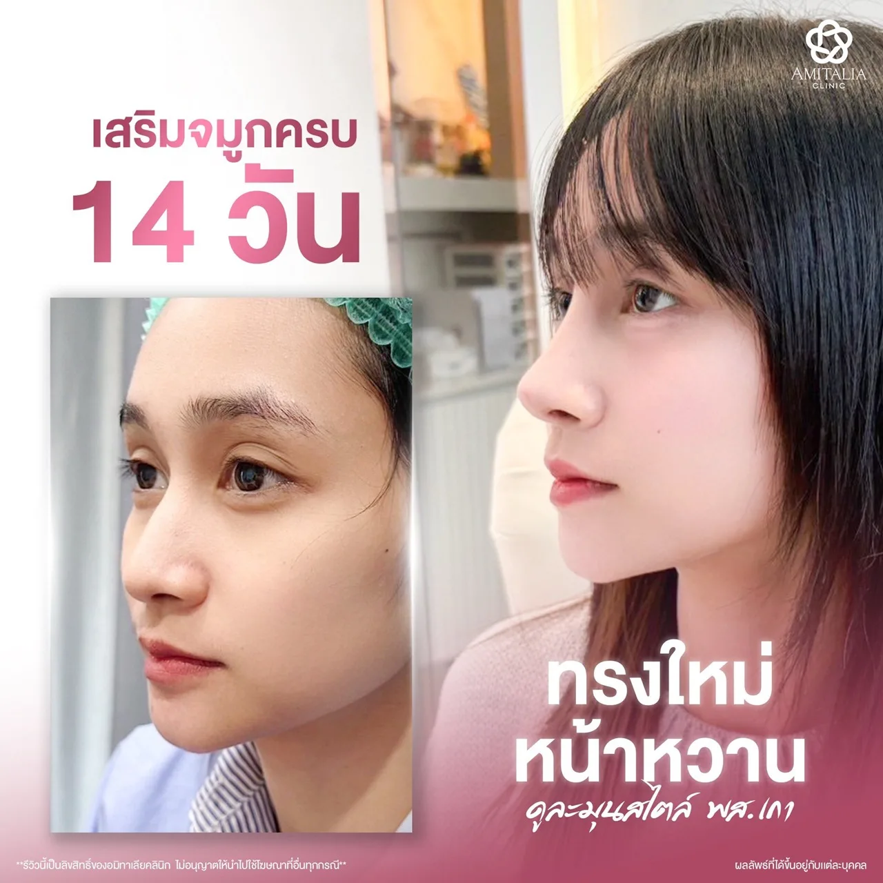 ทรงจมูก
