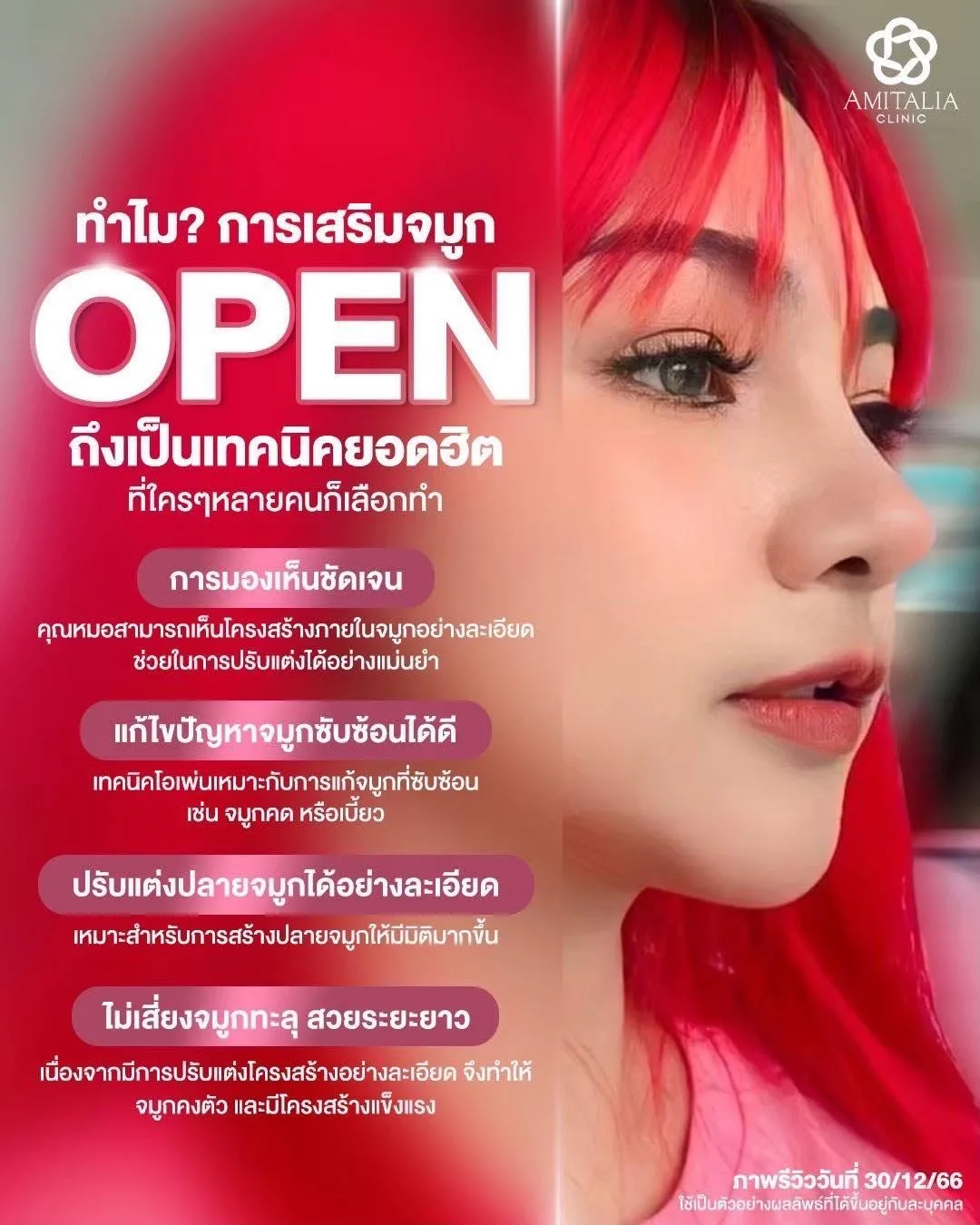 แก้จมูกให้พุ่งสวยปลายละมุนปลอดภัย โด่งพุ่งสวยหวานในมุมเดียวกัน