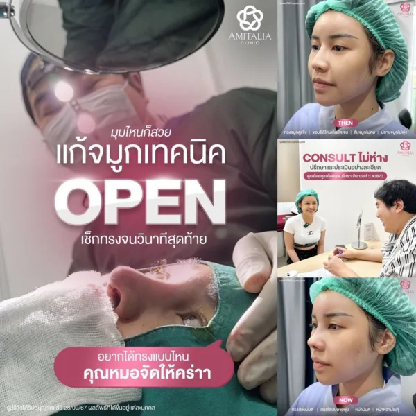 แกนจมูกพัง