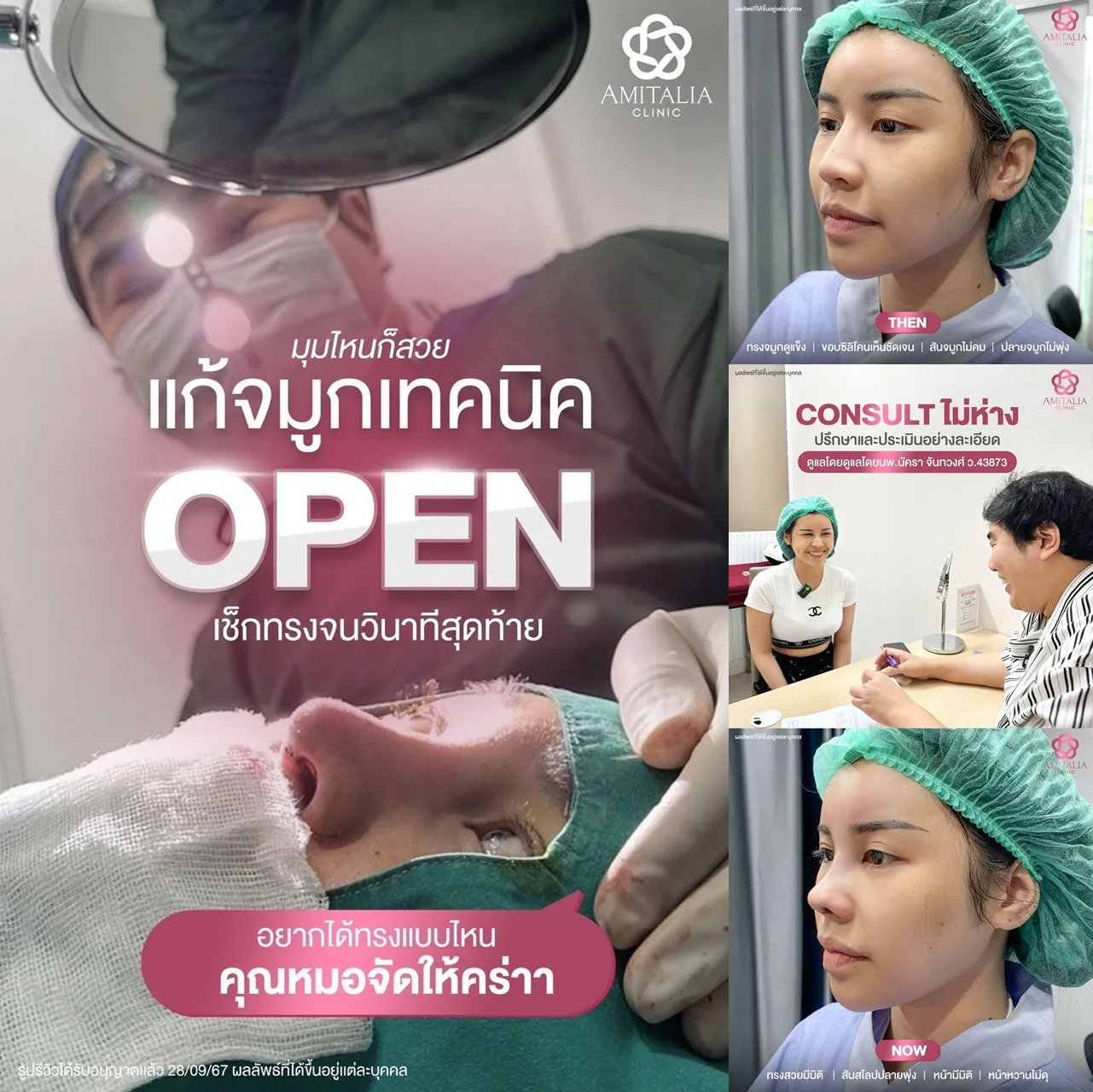 แกนจมูกพัง
