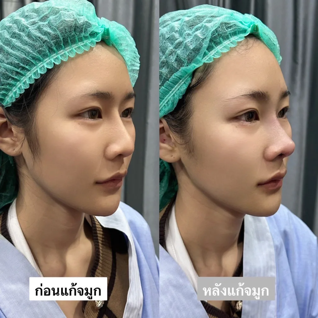 แก้จมูก